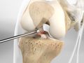ACL Reconstruction with Hamstring