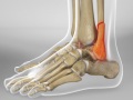 Ankle Fracture Surgery