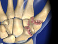 Basal Joint Osteoarthritis