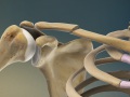 Clavicle Fracture (Broken Collarbone)