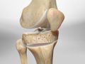 Tibial Osteotomy with Closed Wedge