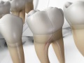 Cracked Tooth Syndrome (CTS)
