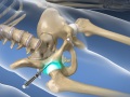 Hip Joint Injection