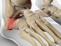 Fracture of the Heel Bone (Calcaneus)