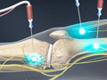 Genicular Nerve Ablation (RF Neurotomy)