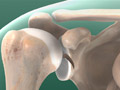 Fracture of the Shoulder Socket (Glenoid Fracture)