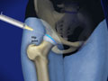 Joint Injection: Hip