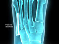 Jones Fracture Fixation (Open Reduction and Internal Fixation)
