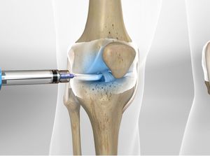 HYALGAN® Injection for Knee Pain (Fluoroscopic Guided)