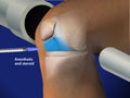 Fluoroscopic Guided Steroid Injection for Knee Pain