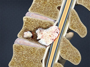 Metastatic Cancer of the Spine