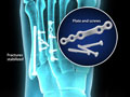 Metatarsal Fracture Fixation (Open Reduction and Internal Fixation)