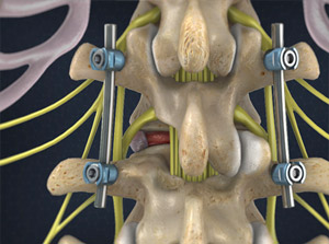 Removal of the facet joint on one side to decompress the nerves. Insertion of pedicle screws connected to rods to fuse spine