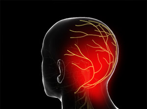Occipital Neuralgia (Arnold's Neuralgia)