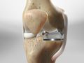 Partial Knee Replacement (using OXFORD® implant)
