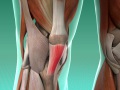 Patellar Tendonitis (Jumper's Knee)