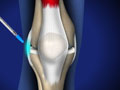Prolotherapy Treatment for Chronic Knee Pain