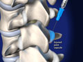 Prolotherapy Treatment for Chronic Lower Back Pain