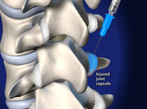 Intradiscal injection steroid