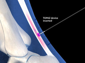 Radiofrequency Treatment for Achilles Tendinosis (TOPAZ® Coblation®)