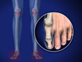 Rheumatoid Arthritis (RA) of the Foot and Ankle (Arthritis Foundation Approved)