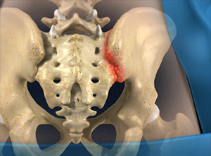 Sacroiliac Joint Steroid Injection