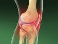 Septic Arthritis (of the Knee)