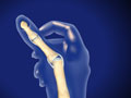 Thumb Ulnar Collateral Ligament (UCL) Injury