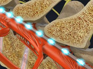 Spinal Cord Stimulator Implant