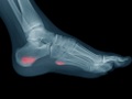 Stress Fractures of the Foot and Ankle