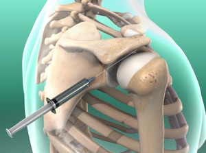 Subacromial Injection