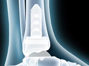 Total Ankle Joint Replacement (Wright INBONE® II)