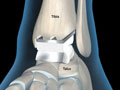 Total Ankle Joint Replacement (STAR™ Mobile-Bearing)