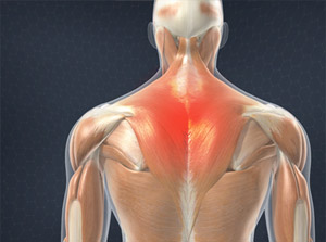 Muscle Strain of the Upper Back (Trapezius Strain)