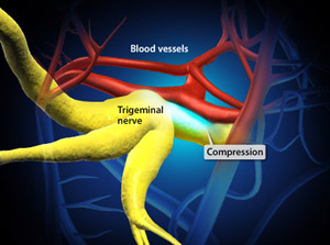 Trigeminal Neuralgia, blood vessels, compression