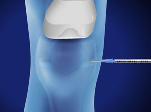 Non steroid injections for knee pain