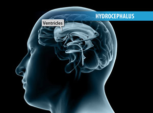 Hydrocephalus is a condition that develops when excess cerebrospinal fluid builds up within the ventricles of the brain