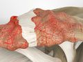 Acromioclavicular (AC) Joint Arthritis