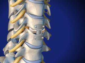 Anterior Cervical Discectomy and Fusion (Intervertebral Spacer)