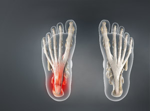 Education about plantar fasciitis and chiropractic care