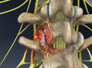 Foraminotomy (Lumbar Spine)