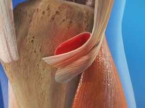 Bursitis of the Knee (Pes Anserine Bursitis) 