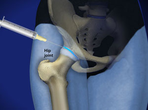 Joint Injection: Hip
