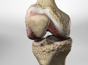 Osteoarthritis of the Knee