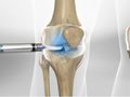 HYALGAN® Injection for Knee Pain (Fluoroscopic Guided)