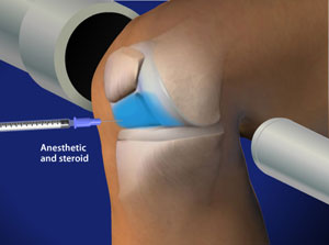 Fluoroscopic Guided Steroid Injection for Knee Pain