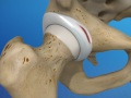 Labral Tear of the Hip (Acetabular Labrum Tear)