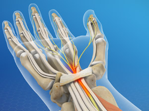 open carpal tunnel surgery