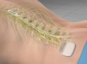 Spinal Cord Stimulation (Paddle Lead)