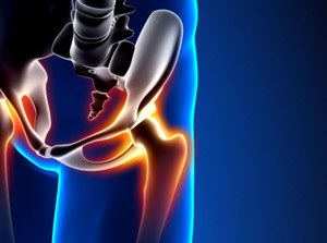 PRP Therapy for Hip Arthritis (AcCELLerated Biologics)